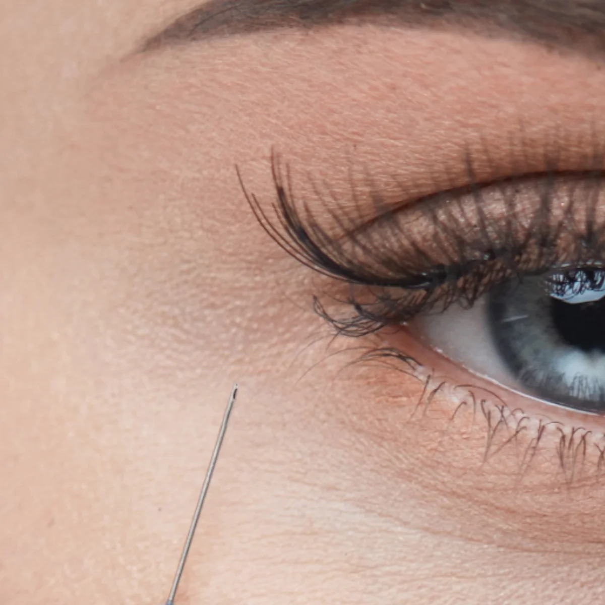 Microcânula fill·k em aplicação periorbital — detalhe de precisão